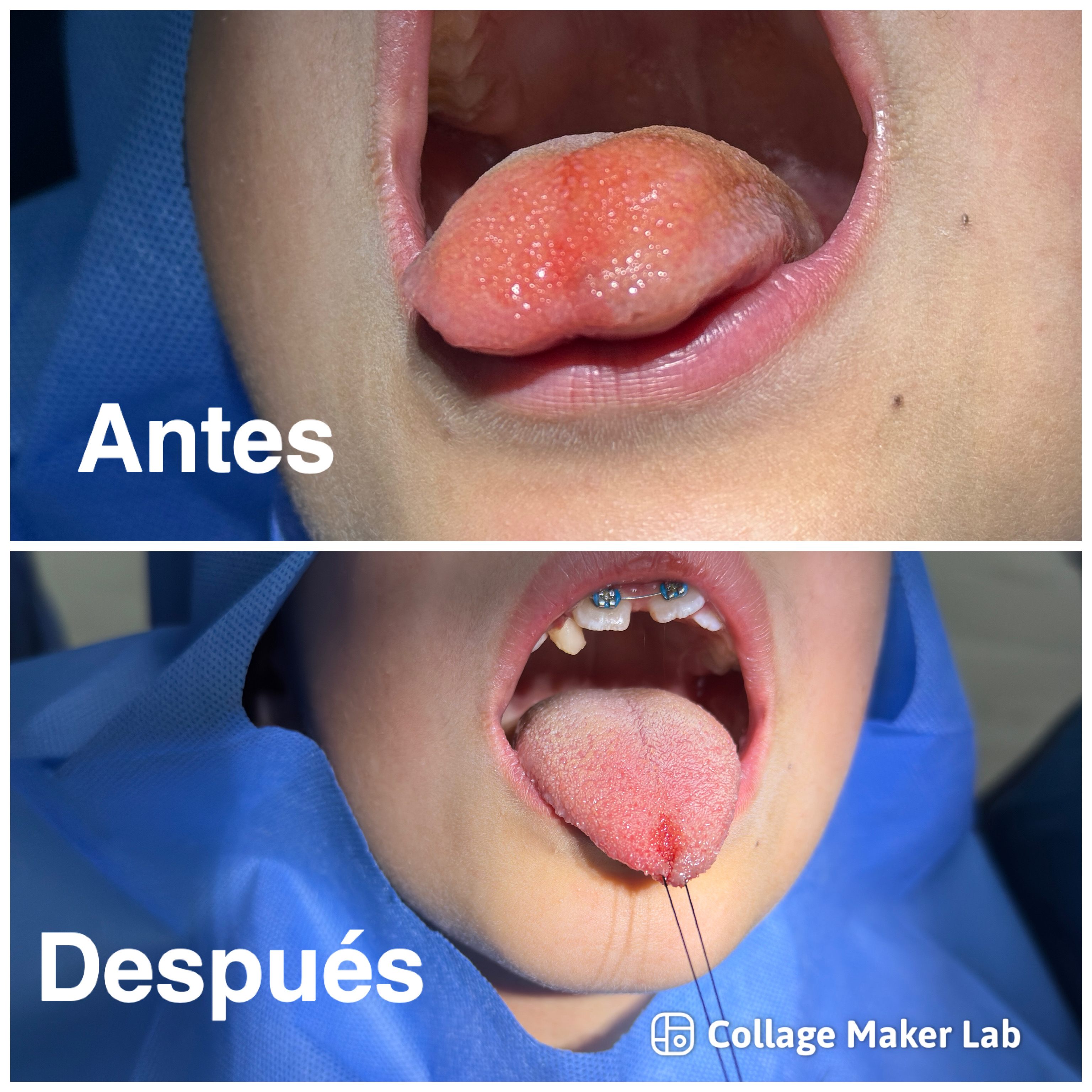 Frenectomía lingual antes y después